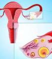 卵巢早衰想做试管婴儿，该怎么进行先前调理?