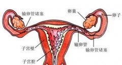 输卵管堵塞情况有哪些？