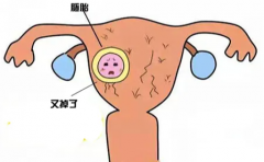 试管移植前为什么做宫腔镜？