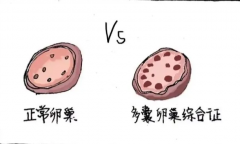 多囊卵巢要怎么调理容易怀孕