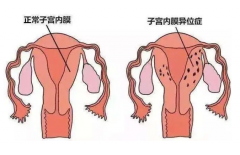 子宫内膜异位症与女性不孕有关吗