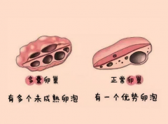 多囊卵巢综合征真的怀不了孕吗