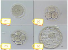 试管婴儿养囊的利与弊